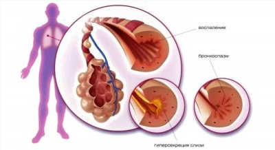 Медицинская комиссия и призывник с бронхиальной астмой