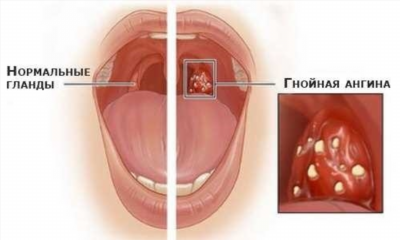 Как понять что ангина дала осложнения?
